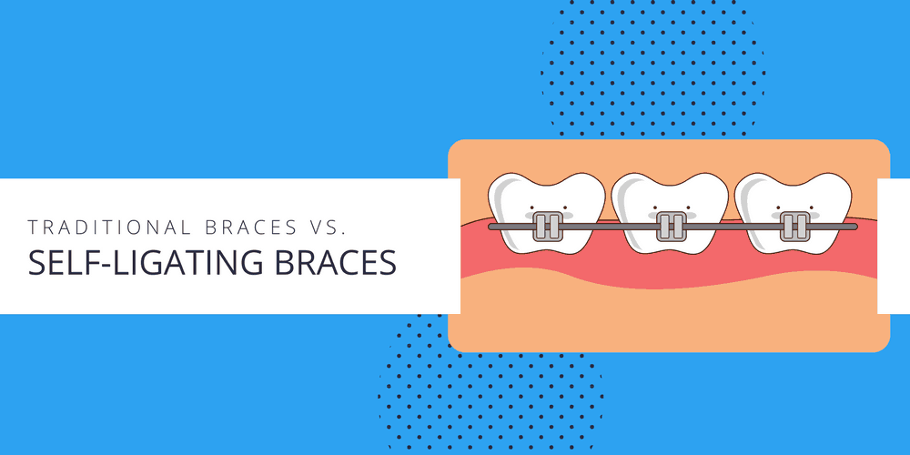 What's The Difference Between Self-Ligating Braces And Traditional