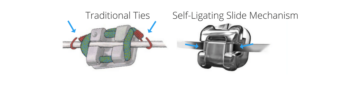 Self-ligating Braces Vs Conventional Braces - Self Ligating Braces