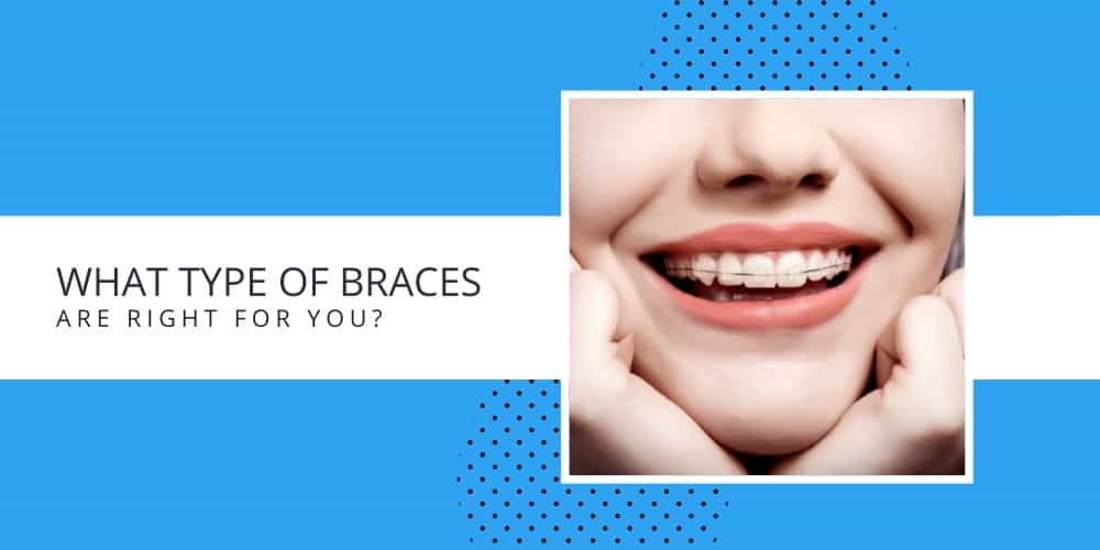 types of braces